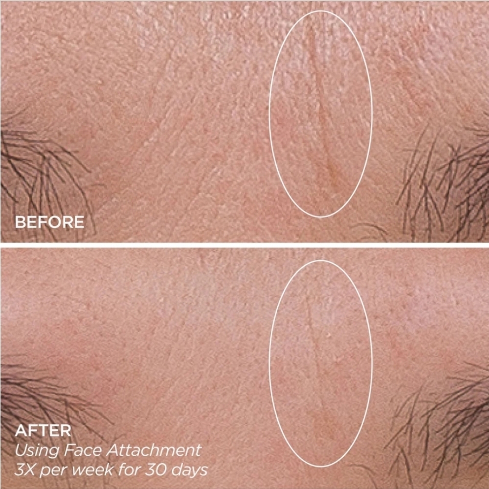 GloPRO Facial Microneedling Tool in LIMITED EDITION PINK STRIPE, New In Case - Picture 6 of 7